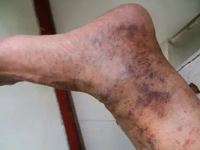 【请教】一侧小腿瘀斑诊断什么合适呢?