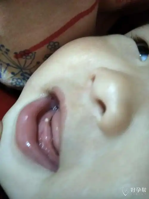 闺女牙龈上长了个白点不知道是什么