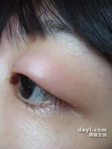 眼睛肿成这个像么办!
