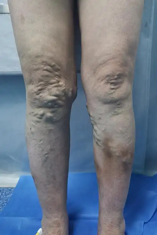 下肢静脉曲张,介入治疗有优势