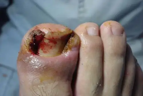 甲沟炎的诊断和鉴别甲周炎的图片