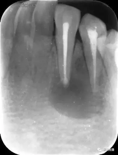 病例根管治疗囊肿刮除根尖切除mta根尖封闭同期完成