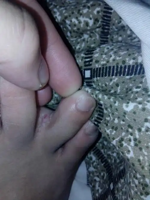 关于脚趾缝脱皮的问题