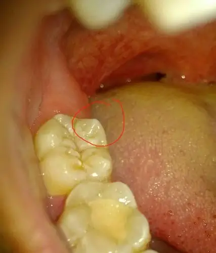 现在前面第七个牙齿前个月,就会酸疼,而且突然觉得嚼东西,牙