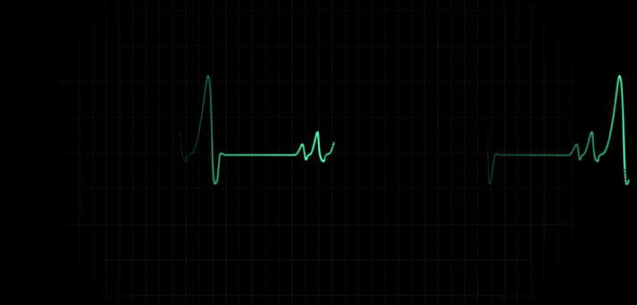 心跳 心电图高清视频素材 医疗视频素材 医学心电图 心脏病视频-好站