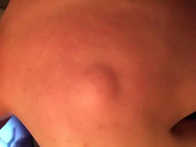 背后长了一个大疙瘩肩部也有一个但是较小第一张图片是背部第二张