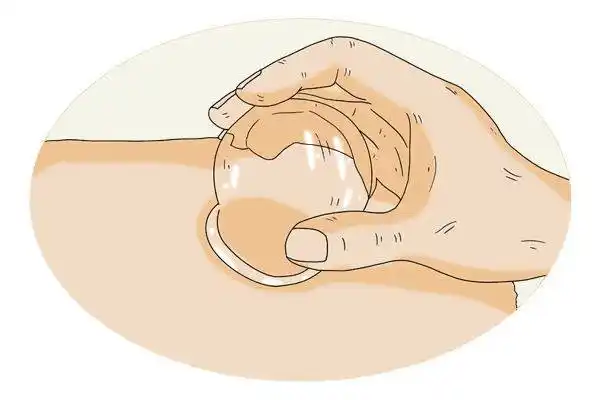 拔罐后身上留下的罐印颜色不一说明了啥拔罐需要注意什么