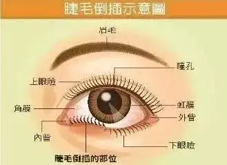 8岁女孩眼角膜烂了差点失明竟是因为这个常见的小动作