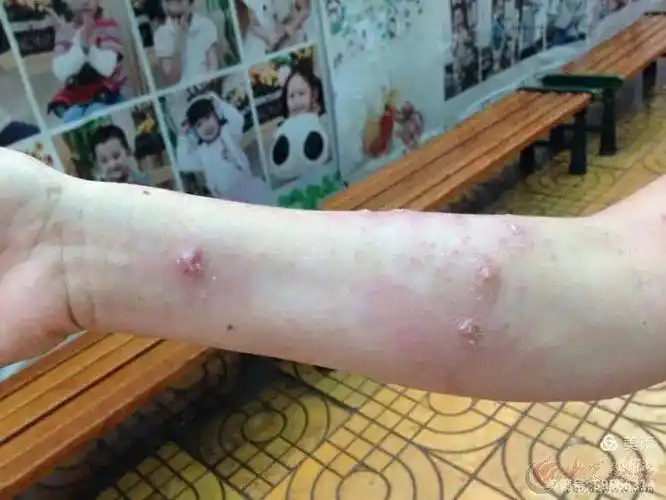 警惕丨红火蚁高发万一被咬请及时就医