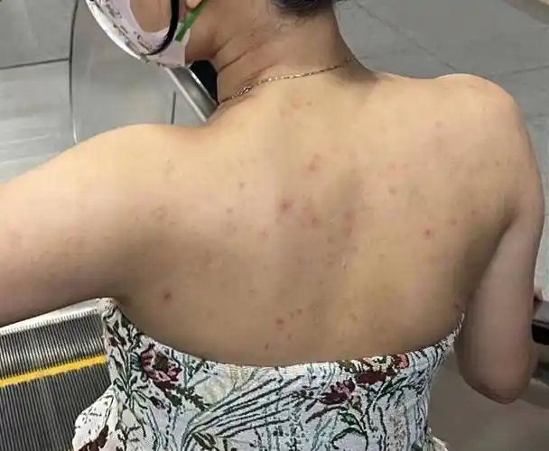 后背粗糙坑坑洼洼全是痘!过来人教你1招!快速祛痘不复发!