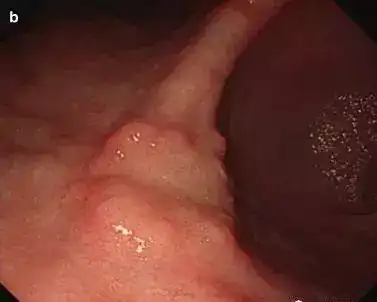 1,腺瘤性息肉大体上可以分为胃底腺息肉,腺瘤性息肉,增生性息肉,特殊