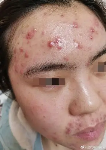 额头和口周长红肿的大痘痘,外用红霉素后爆痘.