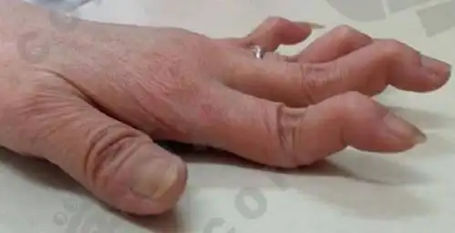 天鹅颈样畸形(图片提供者:姚海红北京大学人民医院风湿免疫科)10年后