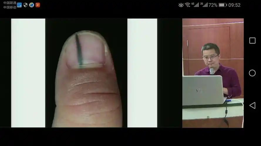 甲黑色素瘤～王雷