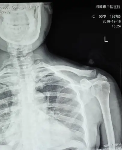 肩锁关节脱位的保守治疗 [病例帖]