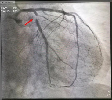 术前回旋支严重狭窄
