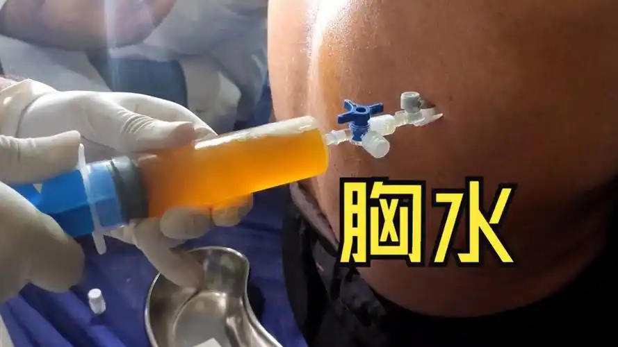 1000毫升胸水 | 胸腔穿刺术