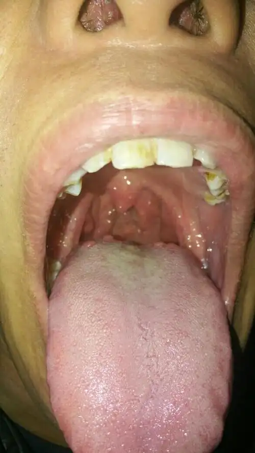 舌头上长了很多肉粒圆圆