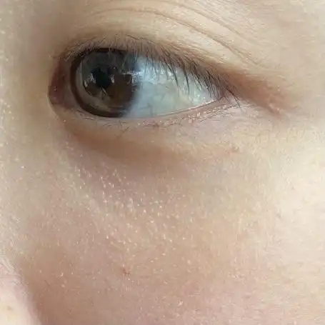 用了维a酸乳膏眼下脂肪粒一点都没改善