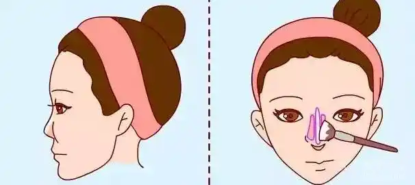 【分享】常见隆鼻失败症状及修复方法!深圳金丽整形医院