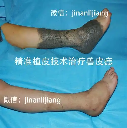 植皮法治疗巨痣兽皮痣配精美彩图