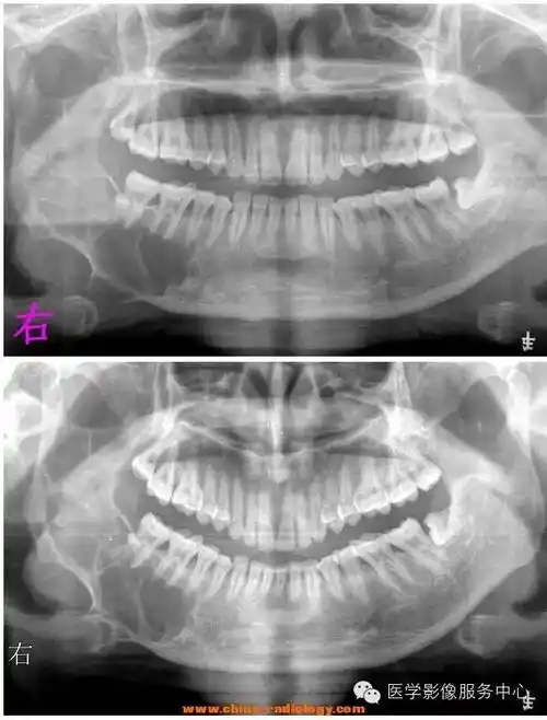 【病例】下颌骨造釉细胞瘤1例x线及ct影像表现
