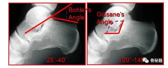 跟骨微创手术的经验与陷阱 - 好医术早读文章 - 好