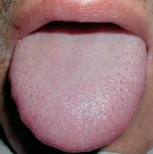 肝癌患者见舌苔润泽是津液上承之征,说明病中津液未伤.