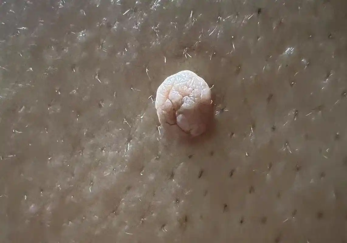 需要手术吗?  医疗的n种可能 图片表现是皮赘也叫软纤维瘤.