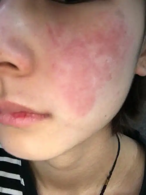 想问一下脸上起的是湿疹吗?因为原来经常起湿疹,但不是这种一大片一