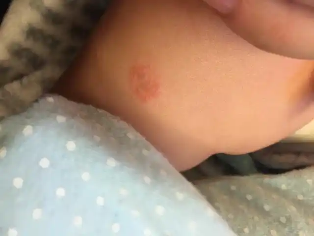 宝宝腿上的 是癣么?五个月大