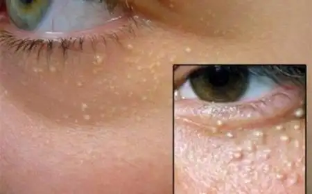 脂肪粒什么意思脂肪粒是啥