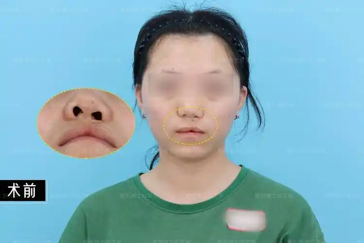 影响了鼻前庭结构的支撑性能,因此会出现鼻小柱短小,鼻中隔向患侧偏斜