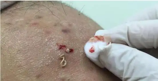 的是呈条形状的话,可能是一种粉刺栓,而且大部分的粉刺栓中含有螨虫