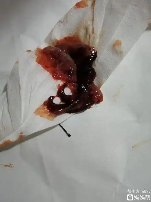 异位妊娠也称宫外孕发生异位妊娠时,一般在停经40天左右出现阴道流血