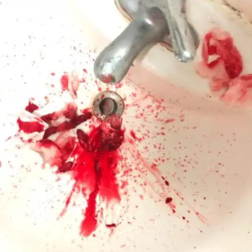 流鼻血鼻衄是怎样的体验