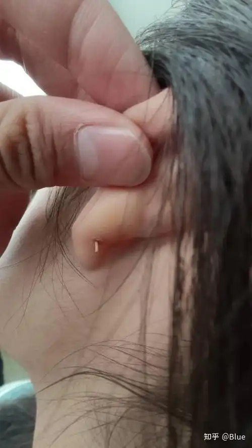 耳洞发炎红肿化脓艰辛恢复历程