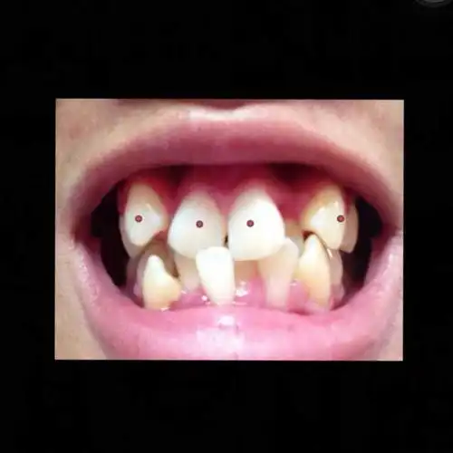 其实还挺对称的 两颗门牙都一样倾斜 门牙旁边的牙齿都缩到后面 然后