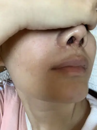 鼻部多项二十天了刚刚做完右侧鼻孔里面就出现一个肉疙瘩一直到现在