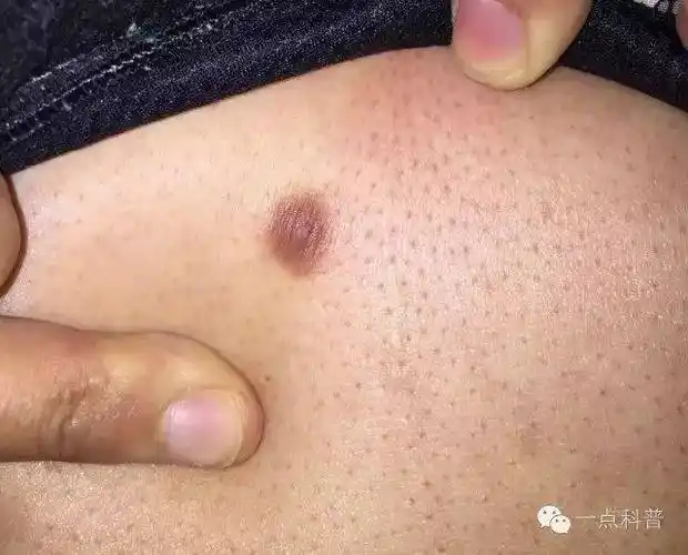 腿上长了个特别硬的疙瘩,是瘤吗?会癌变吗?