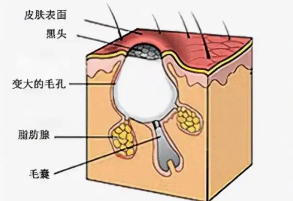 黑头长期不挤会变成什么样子黑头是怎么形成的如何彻底根除
