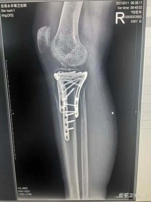 胫骨平台粉碎性骨折,未来可期吗?