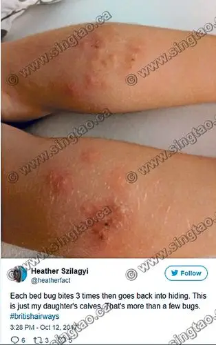 英航机舱内遭床虱咬 卑诗妇全家大小遭殃