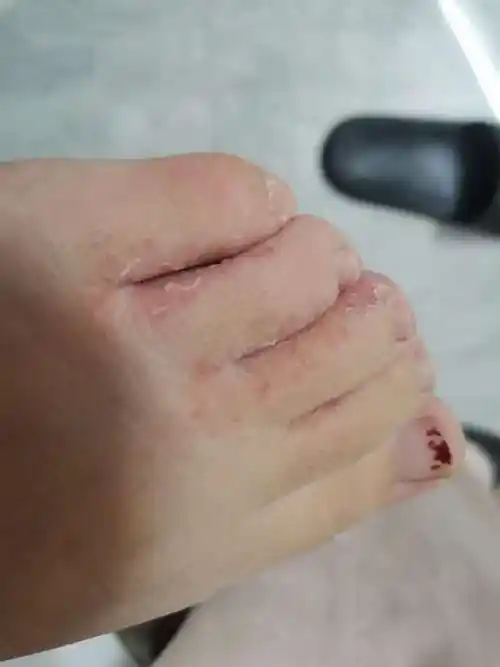 脚趾缝起小水泡很痒是怎么回事?脚气还是真菌感染?_鞋子_外用_较好的