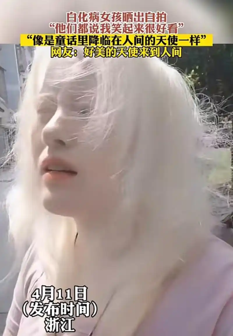 白化病女孩晒出自拍 "他们都说我笑起来很好看"