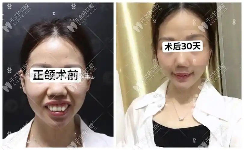 正颌手术后脸型改变图分享,有偏颌/凸嘴/地包天前后对比照 - 行业资讯