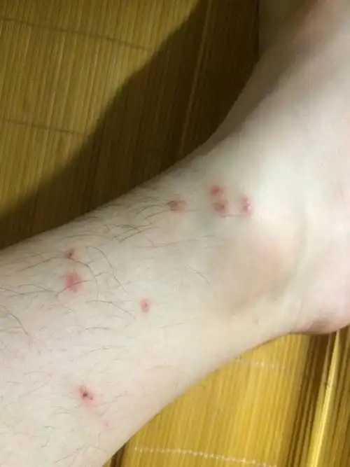 脚上不知道被什么咬了,也不痒,大家帮忙看看是什么虫子咬的