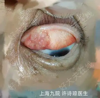 术前同一部位反复"霰粒肿"切除后复发3次,最后一次活检显示睑板腺癌