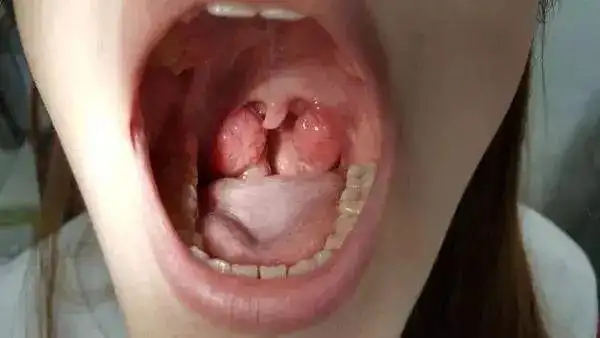 【科普】你的扁桃体切"错"了吗?_切除