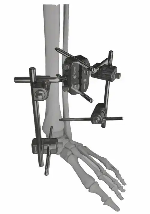 组合式胫骨远端独立外架